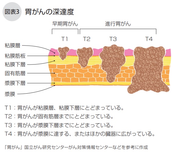 胃がんの深達度