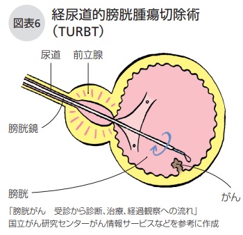 経尿道的膀胱腫瘍切除術(TURBT)