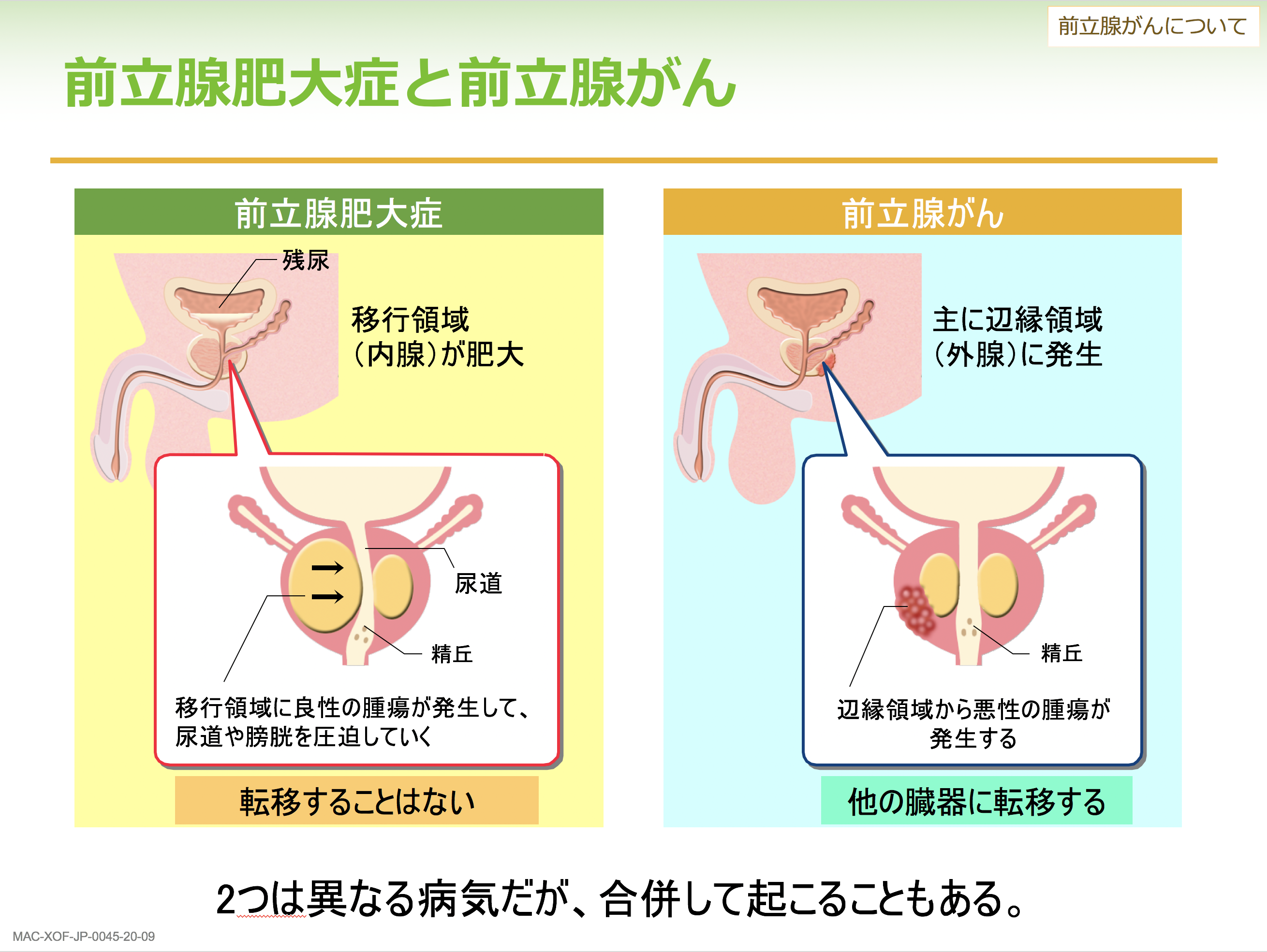 肥大 予防 前立腺