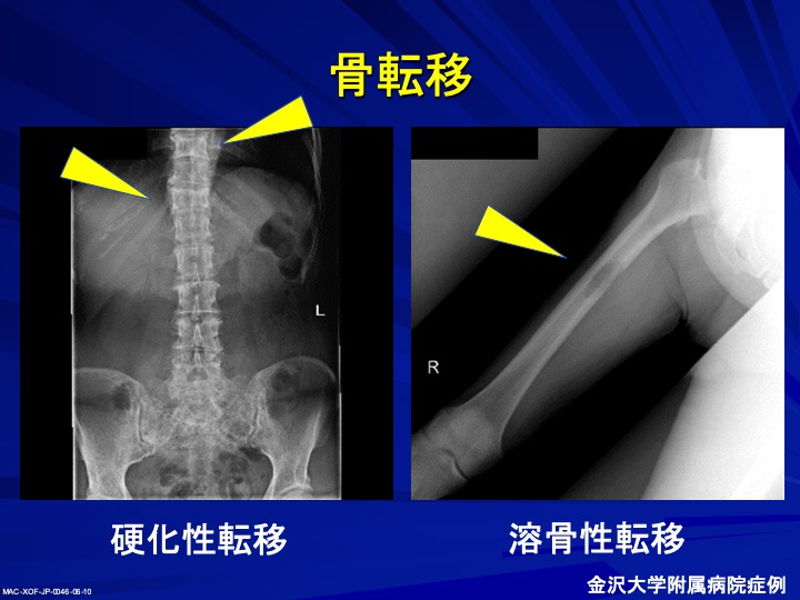 症状 骨 転移