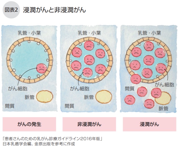 浸潤がんと非浸潤がん