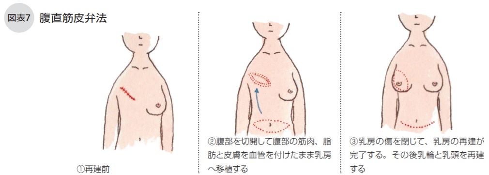 腹直筋皮弁法
