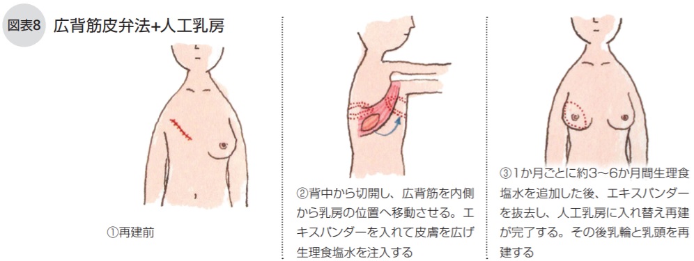 広背筋皮弁法+人工乳房