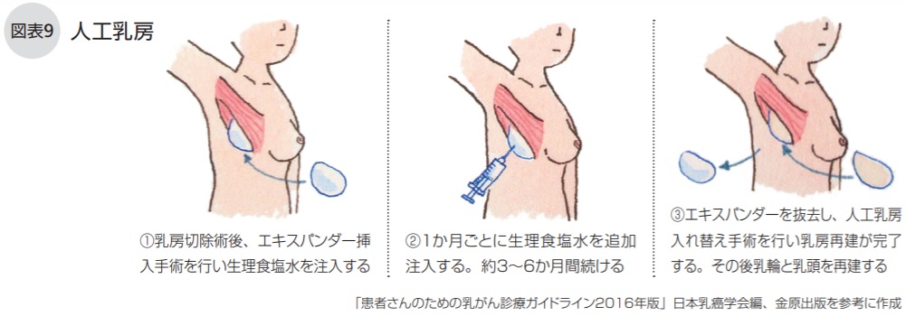 人工乳房