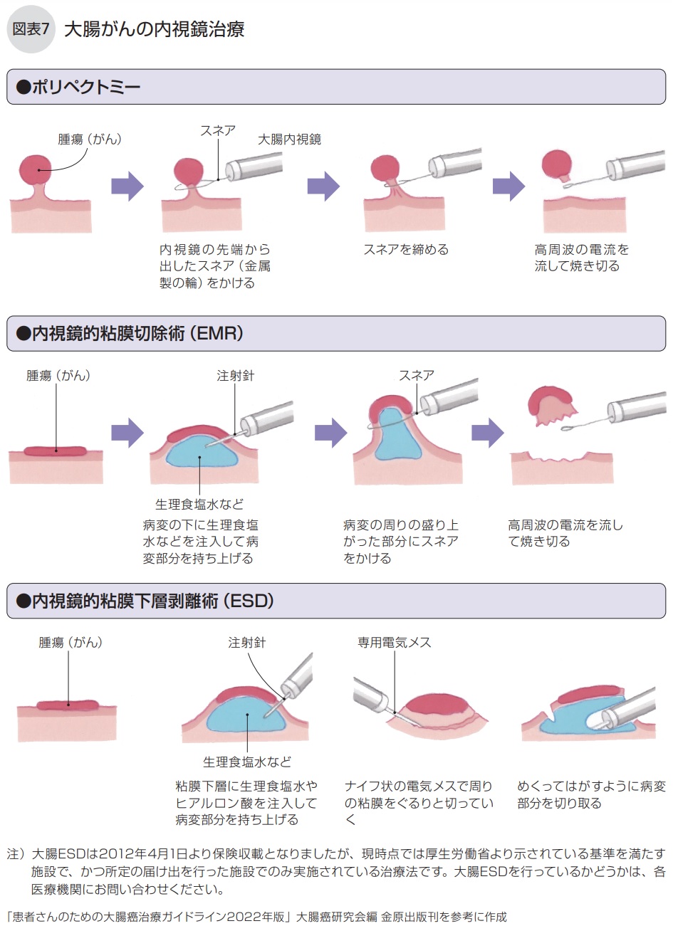 大腸がんの内視鏡治療