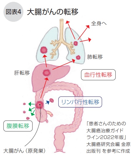 大腸がんの転移