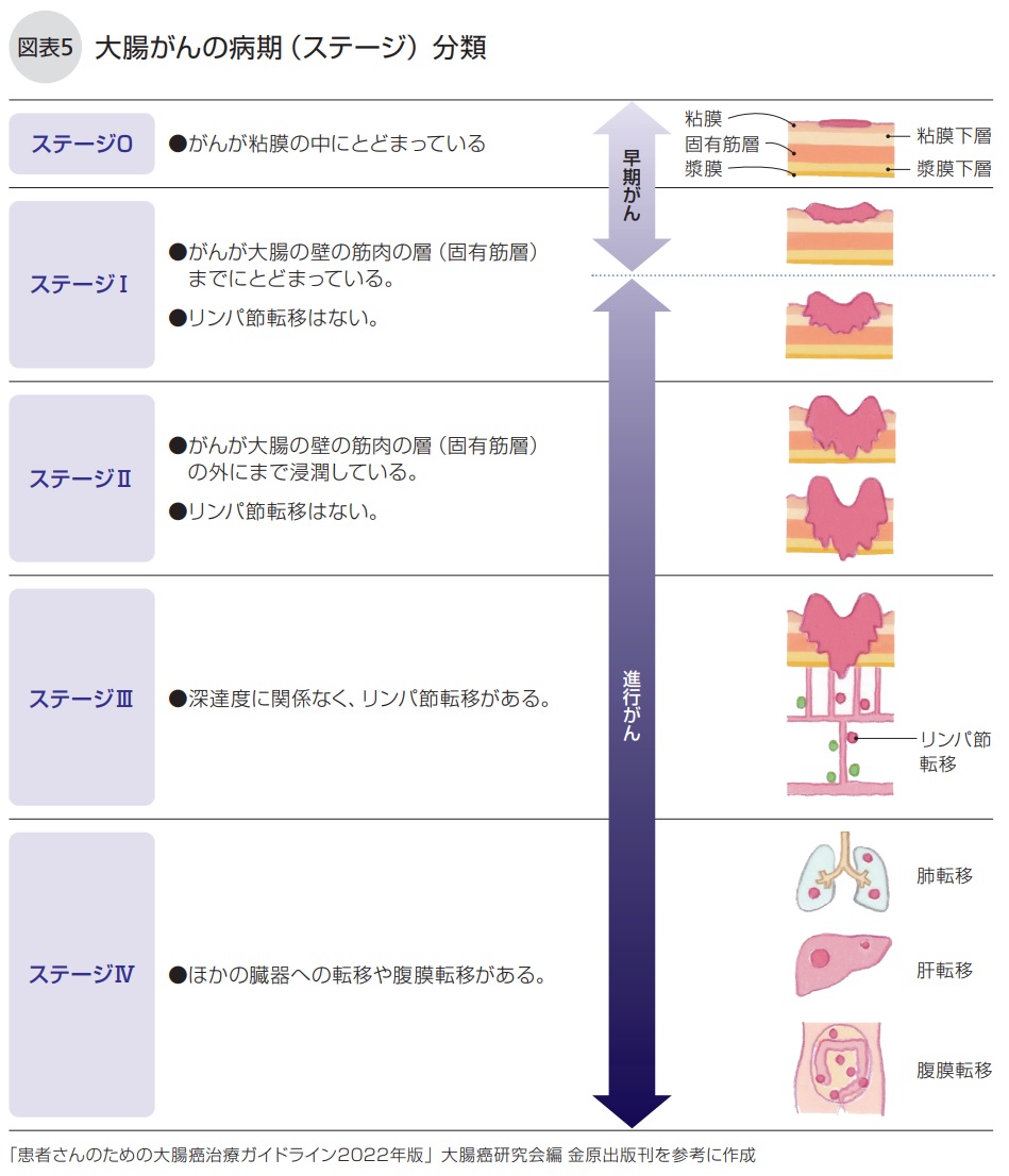 大腸がんの病期（ステージ）分類