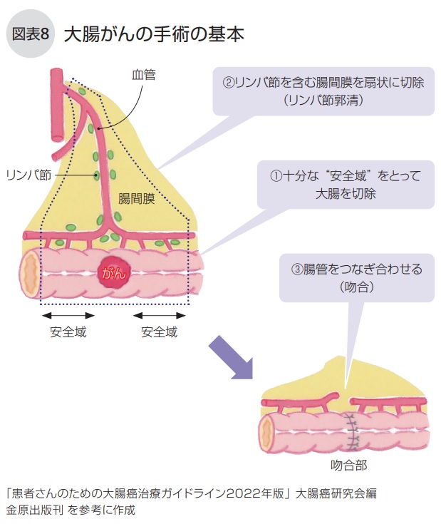 大腸がんの手術の基本