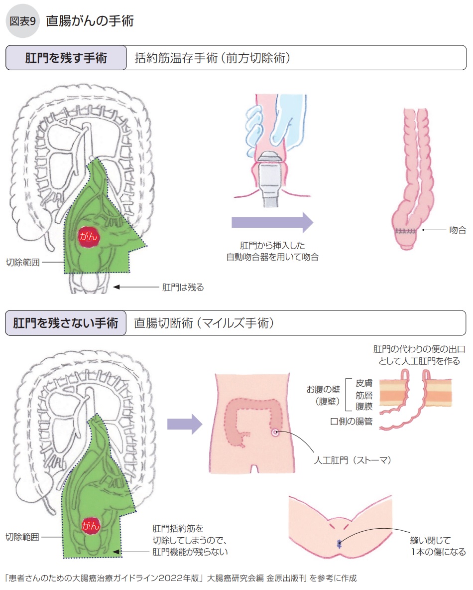 直腸がんの手術