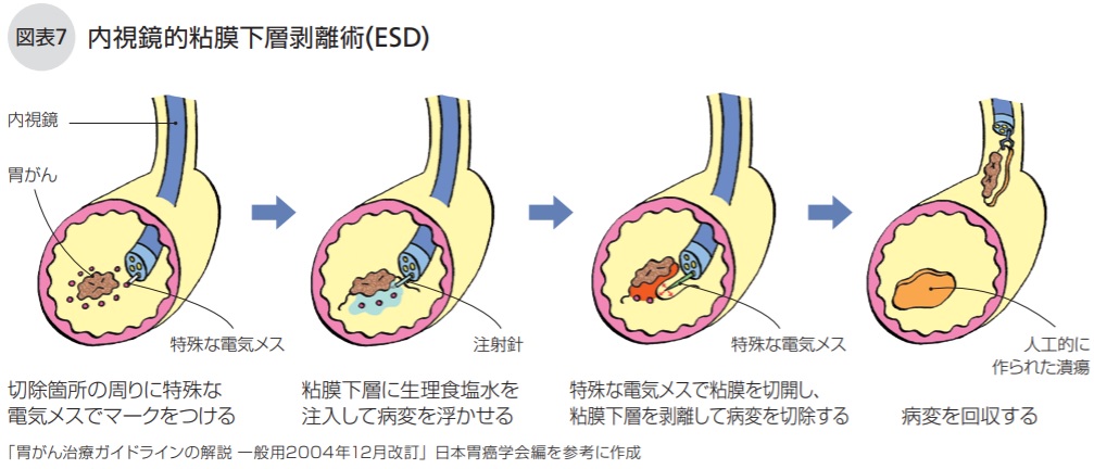 内視鏡的粘膜下層剥離術(ESD)