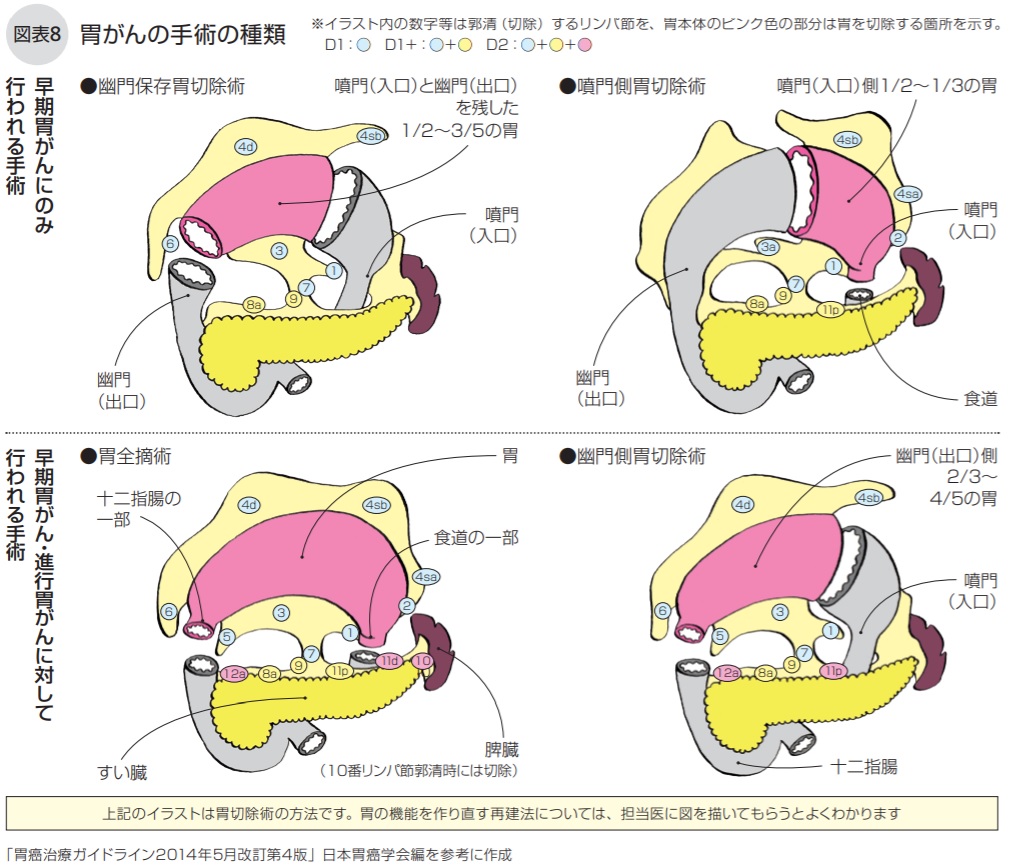 胃がんの手術の種類