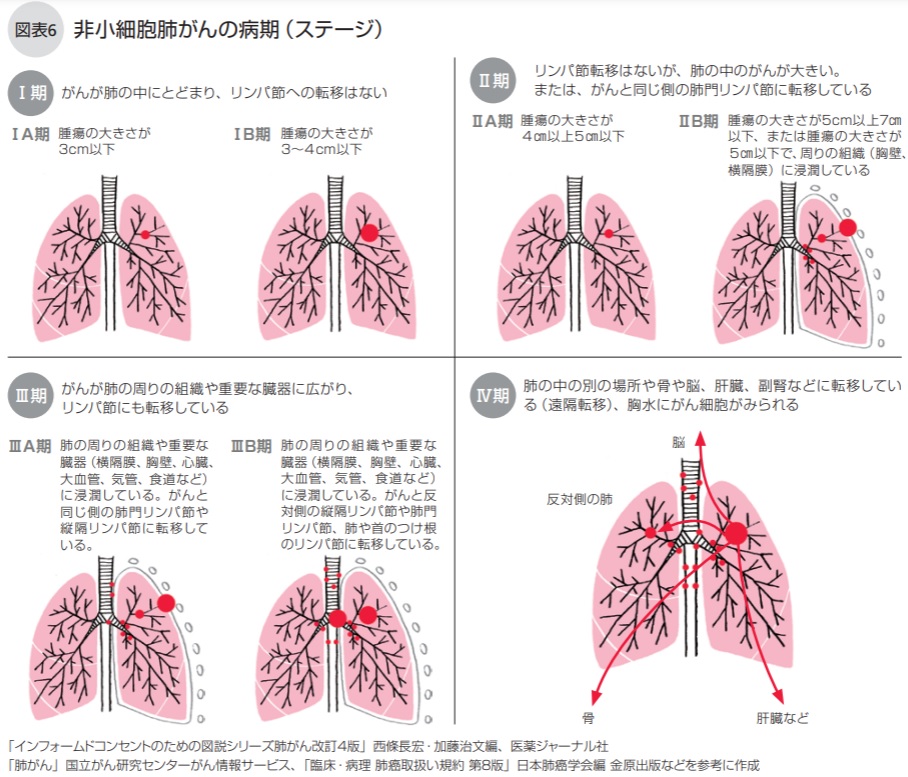 非小細胞肺がんの病期（ステージ）