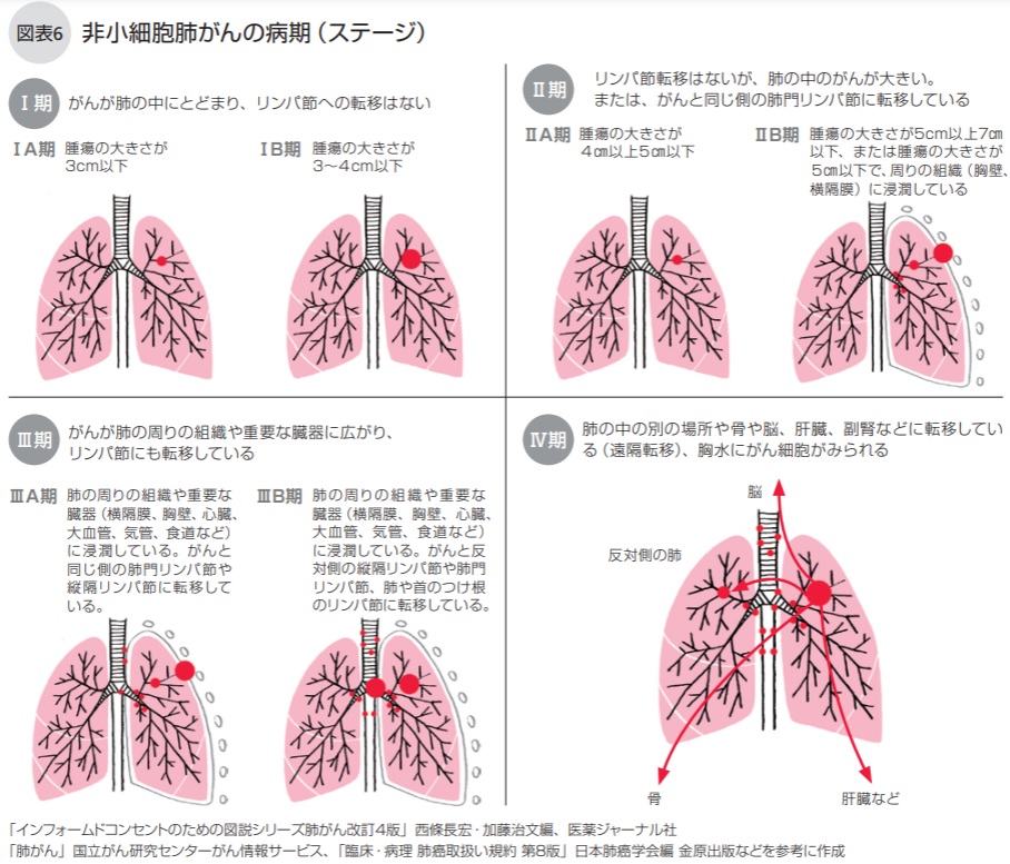 肺がんの病期 ステージ Npo法人キャンサーネットジャパン