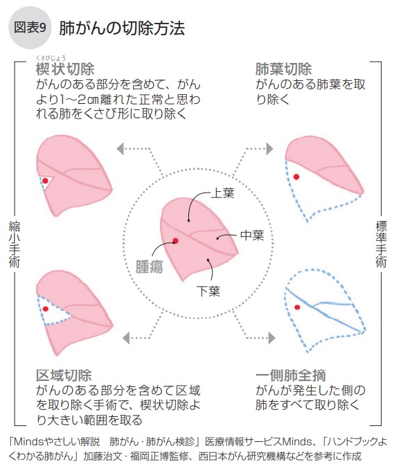 肺がんの切除方法