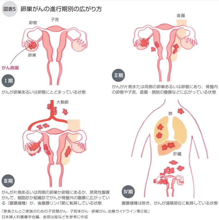 卵巣がんの進行期別の広がり方