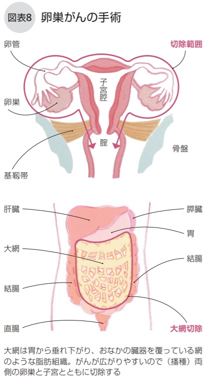 卵巣がんの手術