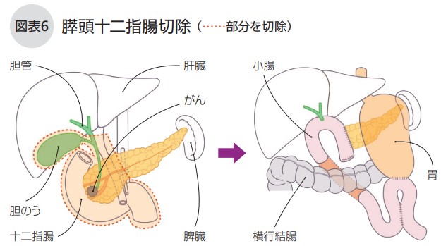 膵頭十二指腸切除