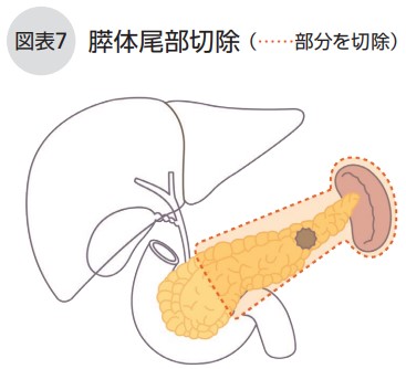 膵体尾部切除