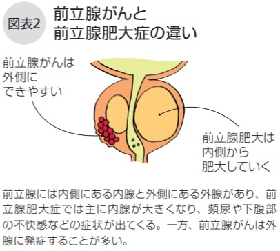 前立腺がんと前立腺肥大症の違い