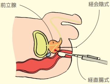 超音波ガイド下針生検