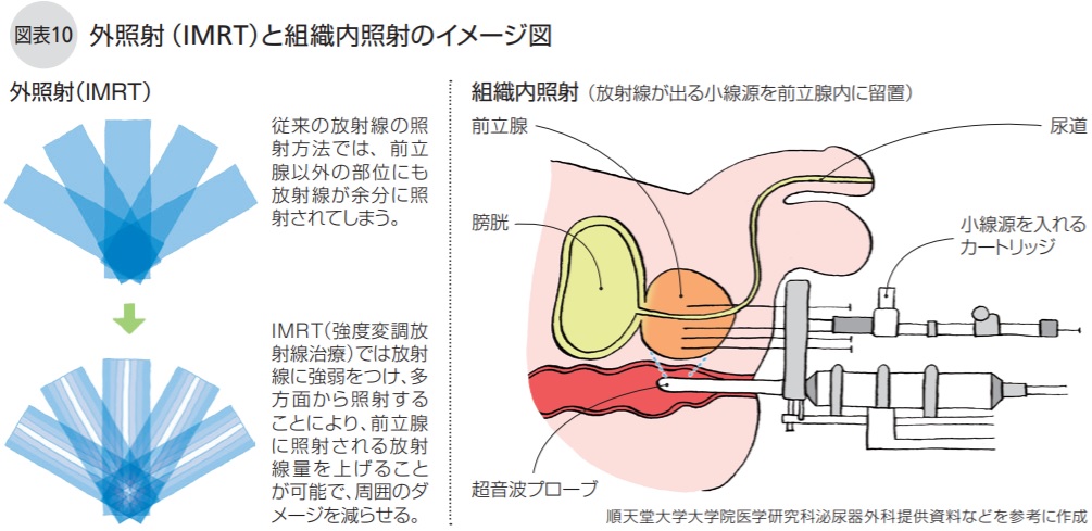 外照射（IMRT）と組織内照射のイメージ図