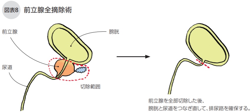 前立腺全摘除術