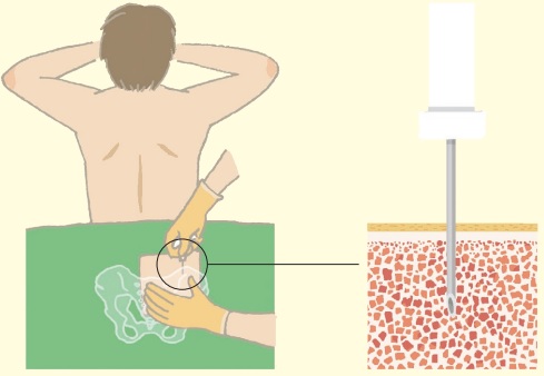 骨髄検査とは