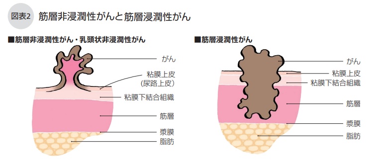 筋層非浸潤性がんと筋層浸潤性がん