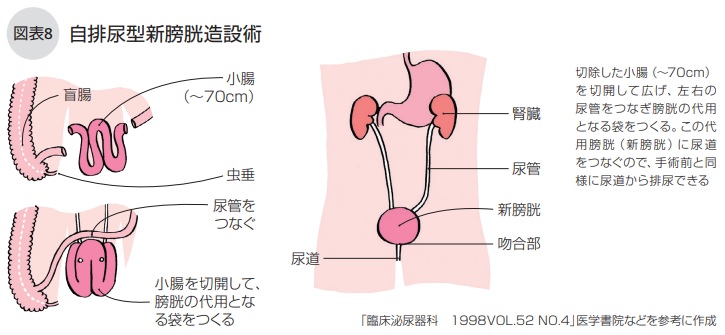 自排尿型新膀胱造設術