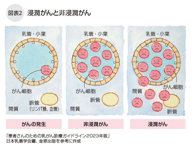 浸潤がんと非浸潤がん