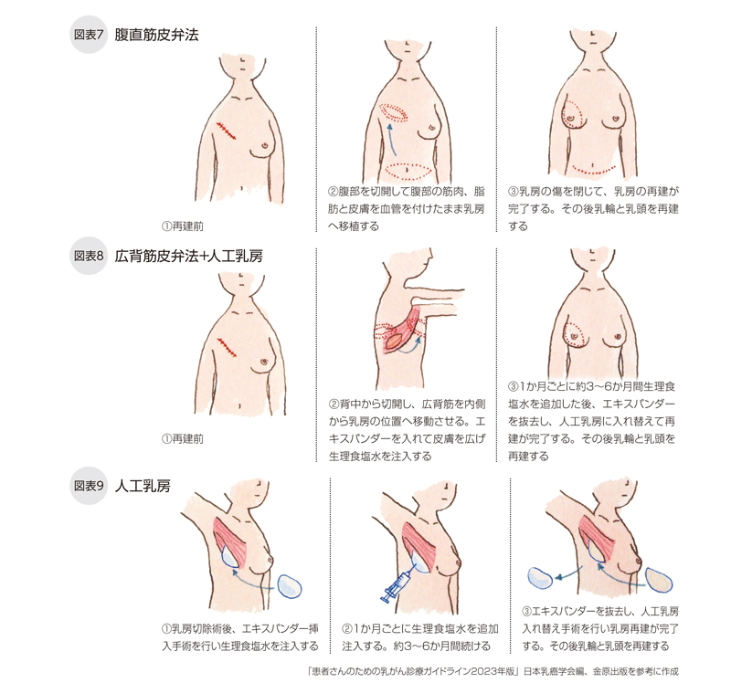 腹直筋皮弁法