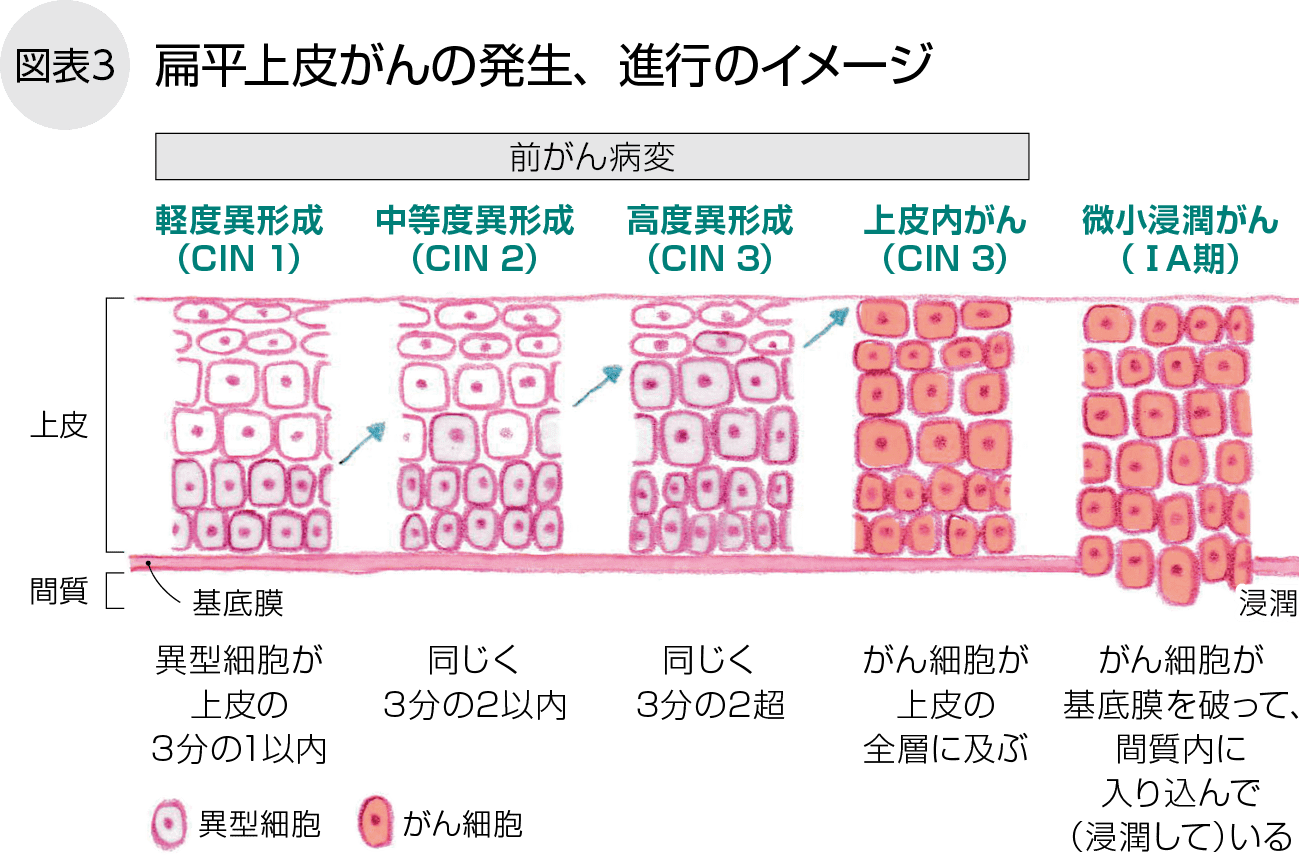 扁平上皮がんの発生、進行のイメージ
