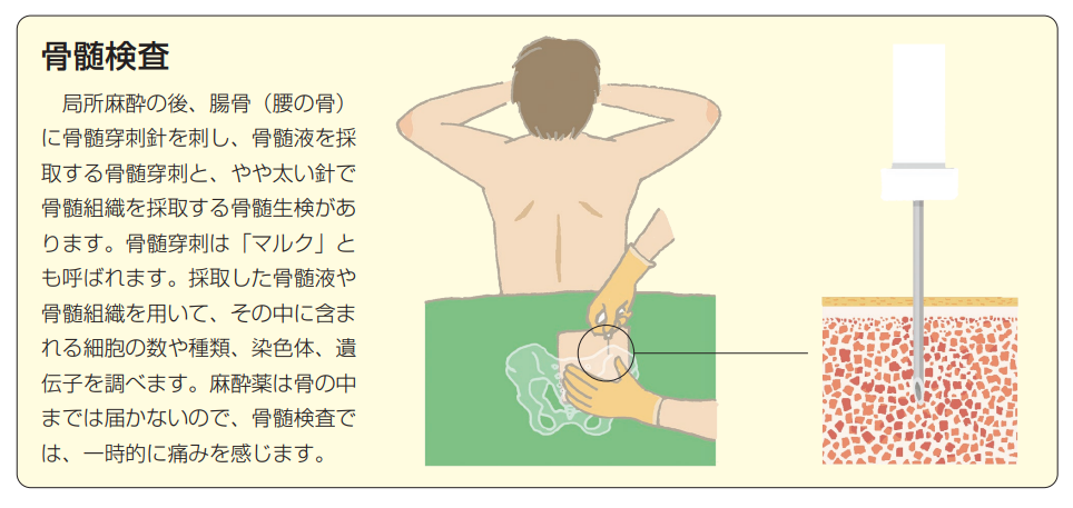 骨髄検査