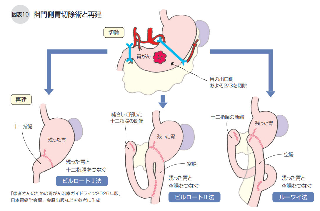 幽門側胃切除術と再建