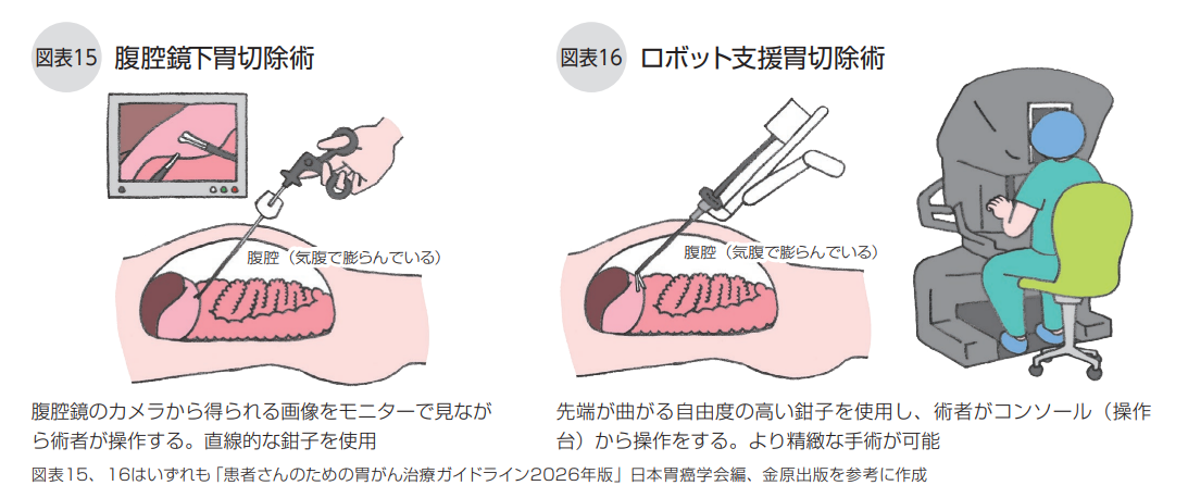 他の切除術について